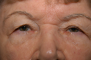 Blepharoplasty 1a